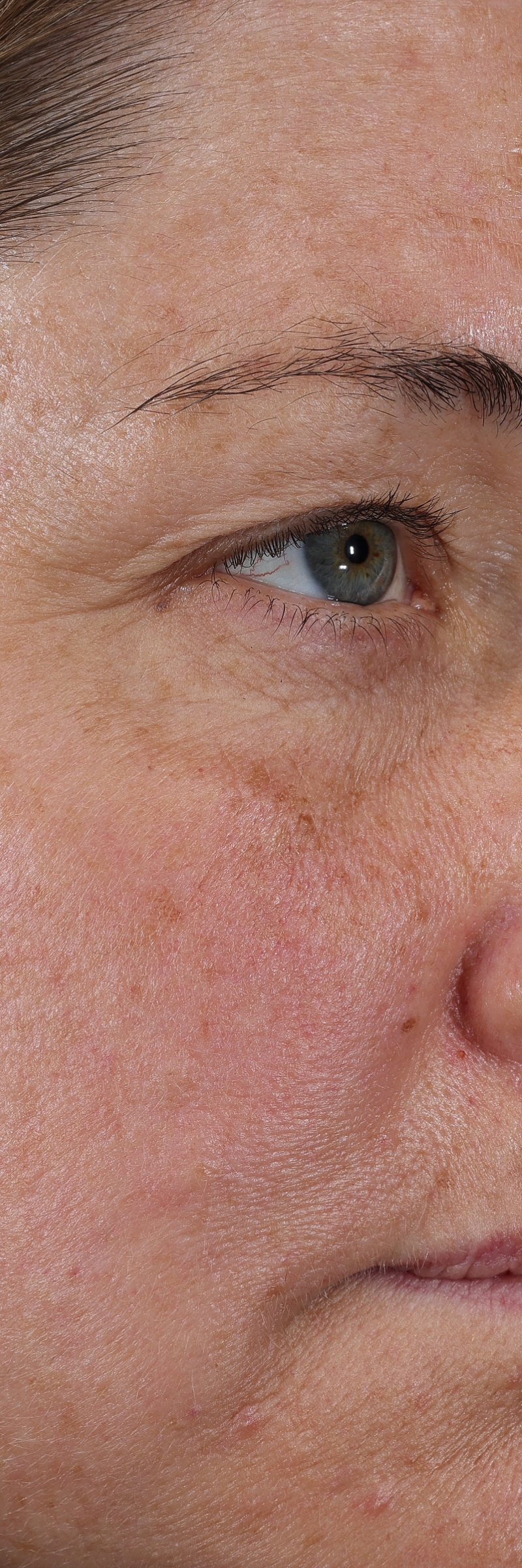Immediately after Deliverance: the same cheek with less visible redness