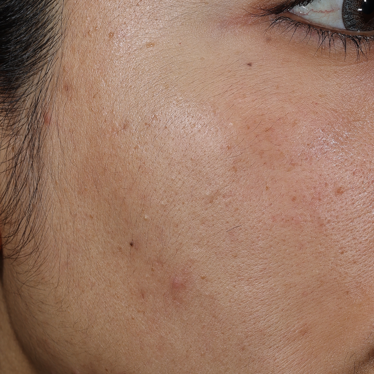 After 8 weeks of Deliverance: the same cheek with a more even tone and fewer visible marks