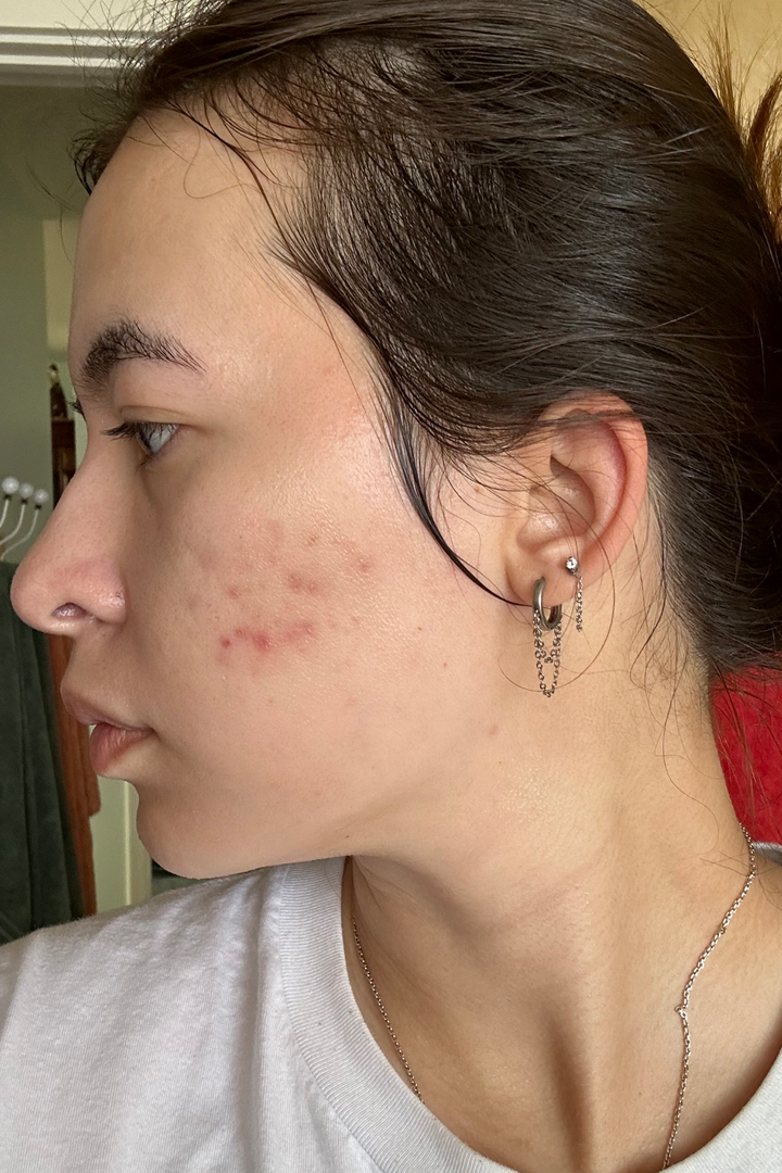 dieux Dieux-profile-view-of-a-person-with-acne-prone-skin-01.