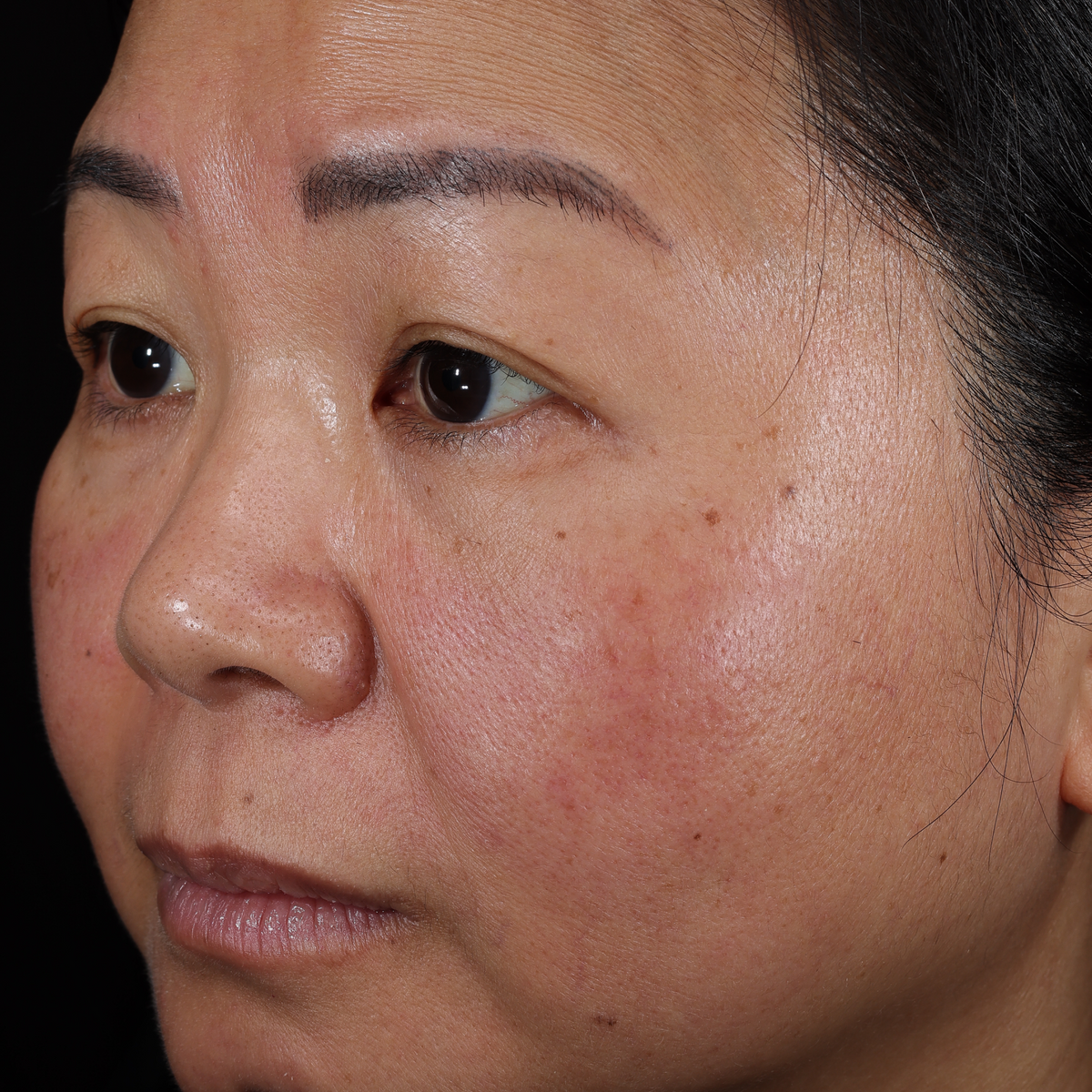 Before Instant Angel: three-quarter view of a woman's face with redness across the cheek