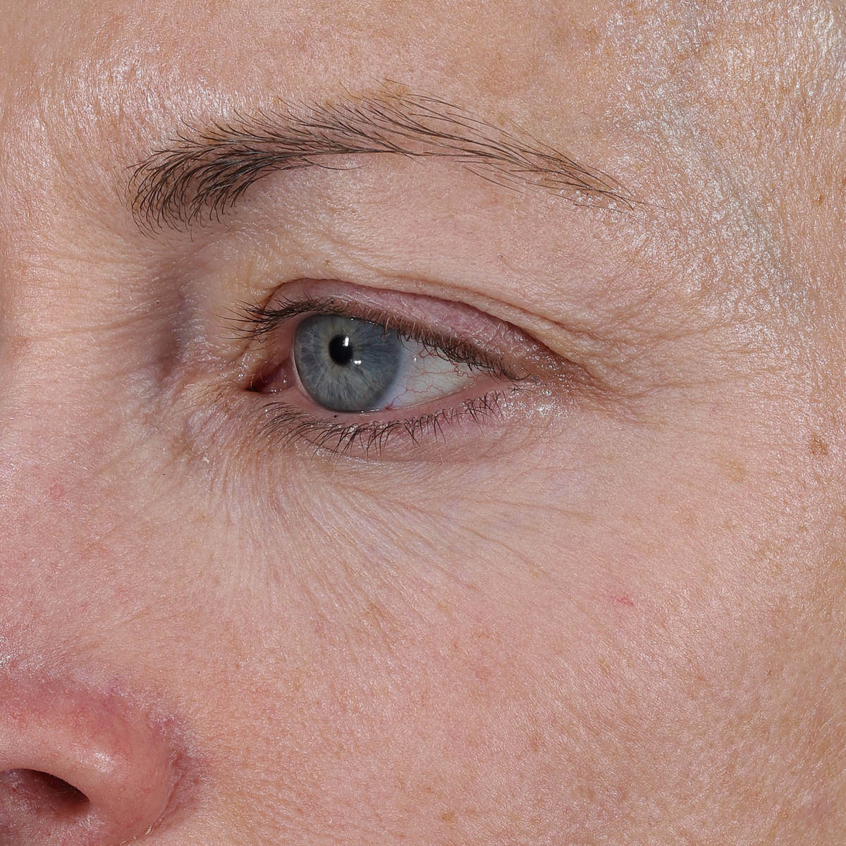 Before Instant Angel: close-up of a woman's eye area with fine lines and dry-looking skin