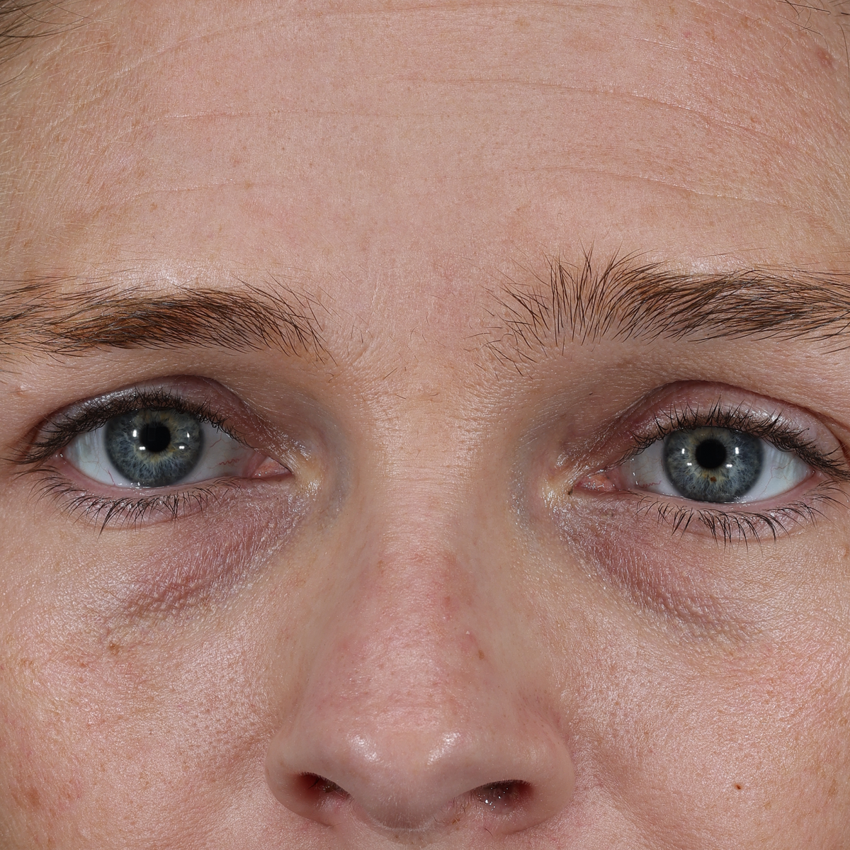 Before Instant Angel: front view of a woman's eyes and brow showing fine lines and under-eye wrinkles